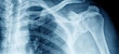 Shoulder xray from urgent care