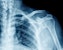 Shoulder xray from urgent care
