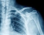 Shoulder xray from urgent care