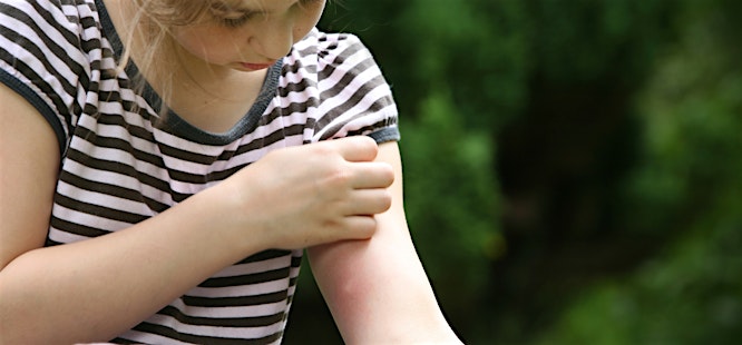 female child scratching a bug bite before visiting medhelp urgent care